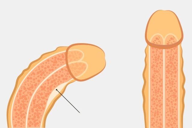 陰茎をまっすぐにする効果的な方法